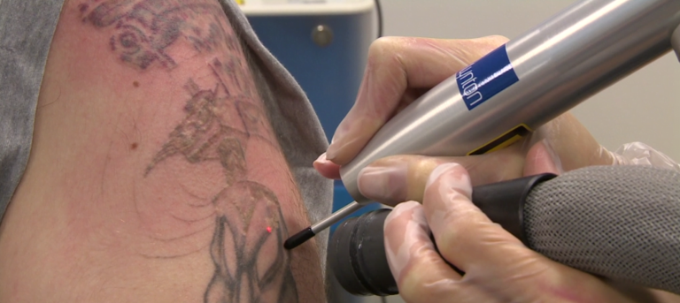 laserless tattoo removal review